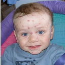 Hautausschlag bei einem Kleinkind