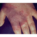 Hautausschlag an der Hand